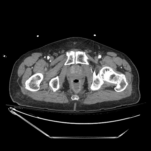 File:Closed loop obstruction due to adhesive band, resulting in small bowel ischemia and resection (Radiopaedia 83835-99023 Axial 294).jpg