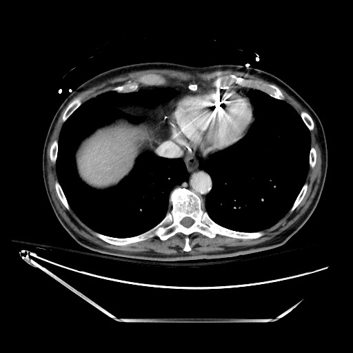 File:Closed loop obstruction due to adhesive band, resulting in small bowel ischemia and resection (Radiopaedia 83835-99023 D 19).jpg