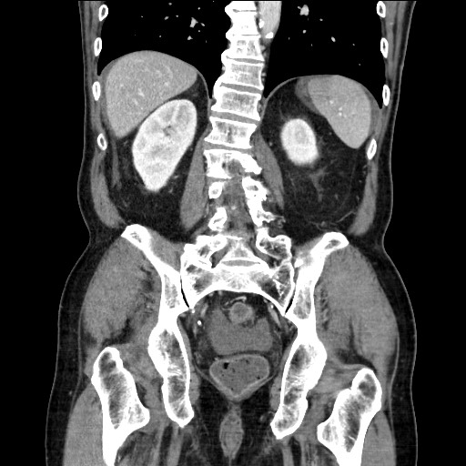 Closed loop obstruction due to adhesive band, resulting in small bowel ischemia and resection (Radiopaedia 83835-99023 E 91).jpg
