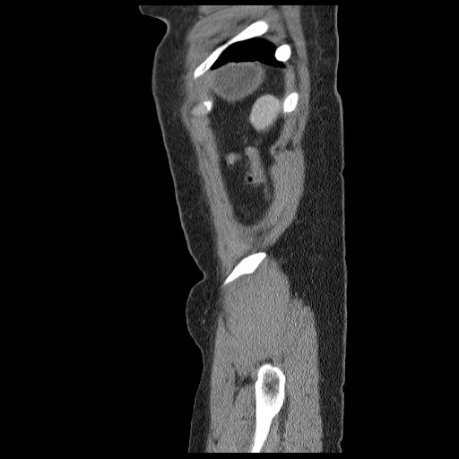 File:Closed loop small bowel obstruction (Radiopaedia 65403-74451 C 103).jpg
