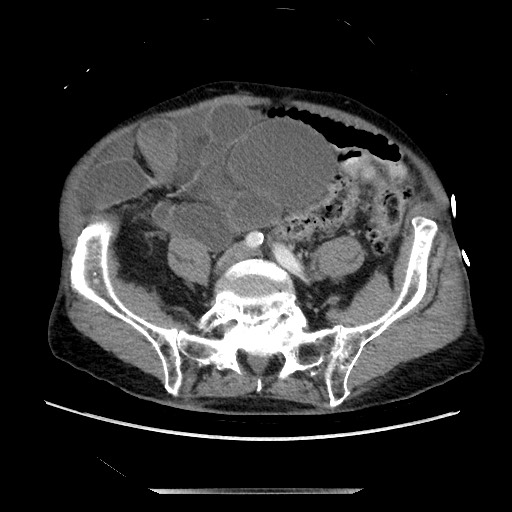 Closed loop small bowel obstruction - adhesive disease and hemorrhagic ischemia (Radiopaedia 86831-102990 A 130).jpg