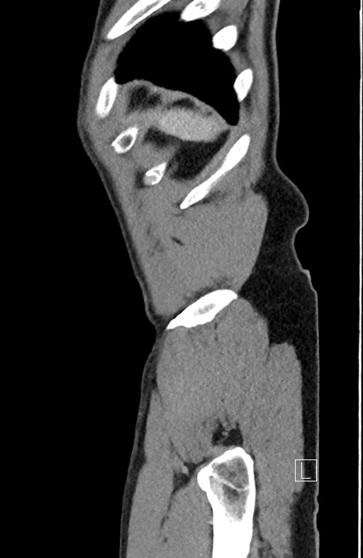 Closed loop small bowel obstruction - internal hernia (Radiopaedia 57806-64778 C 13).jpg