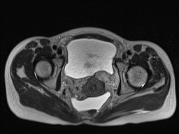 Closed loop small bowel obstruction in pregnancy (MRI) (Radiopaedia 87637-104031 D 35).jpg