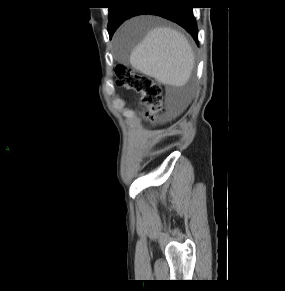File:Closed loop small bowel obstruction with ischemia (Radiopaedia 84180-99456 C 12).jpg