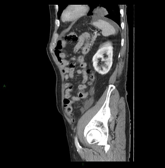 File:Closed loop small bowel obstruction with ischemia (Radiopaedia 84180-99456 C 71).jpg