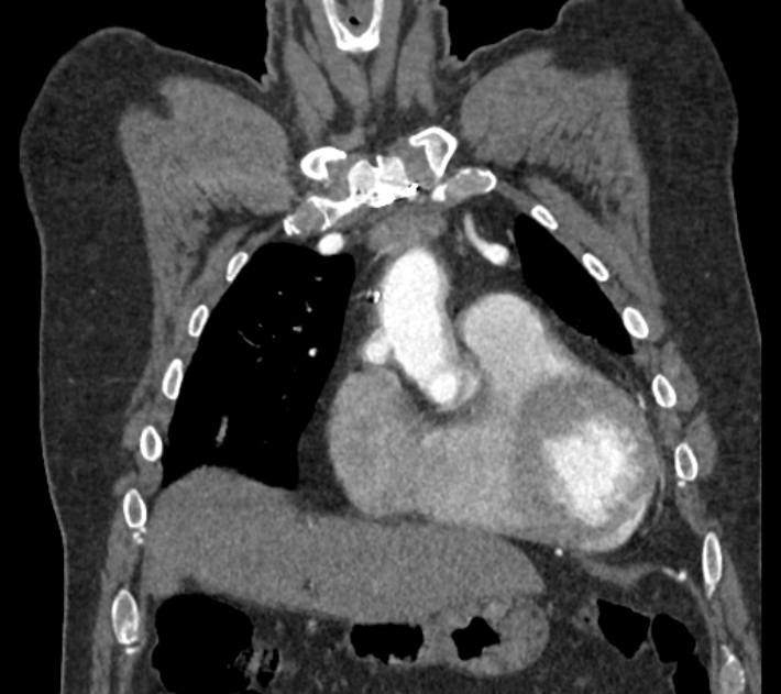 Coarctation of the aorta (Radiopaedia 53752-59822 B 22).jpg