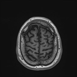 Cochlear incomplete partition type III associated with hypothalamic hamartoma (Radiopaedia 88756-105498 Axial T1 168).jpg