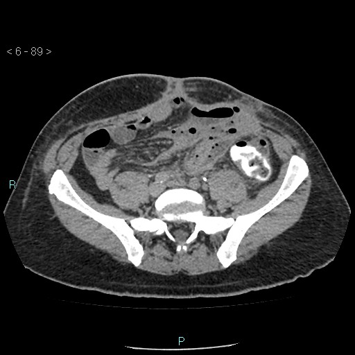 File:Colo-cutaneous fistula (Radiopaedia 40531-43129 A 37).jpg