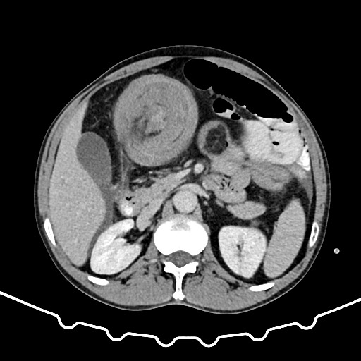 Colocolic intussusception due to large lipoma (Radiopaedia 68773-78482 A 61).jpg