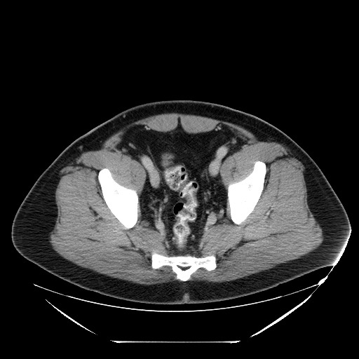 Colocolic intussusception due to lipoma (Radiopaedia 73712-84508 A 101).jpg