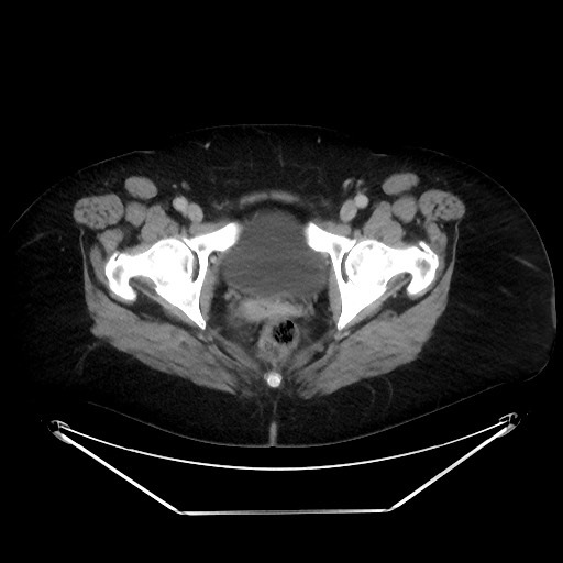 File:Colonic intussusception due to adenocarcinoma (Radiopaedia 86828-102987 A 143).jpg