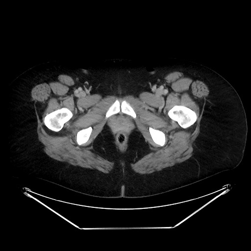 File:Colonic intussusception due to adenocarcinoma (Radiopaedia 86828-102987 A 152).jpg
