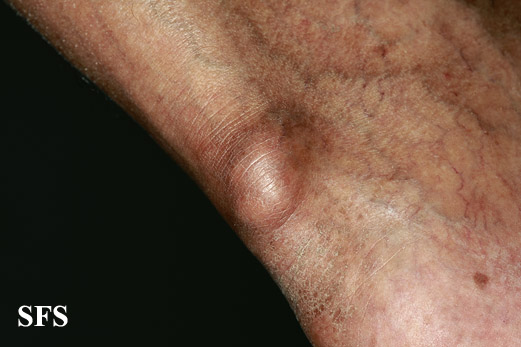 File:Gout (Dermatology Atlas 3).jpg