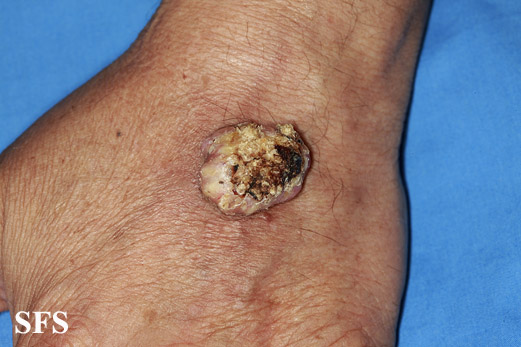 File:Keratoacanthoma (Dermatology Atlas 47).jpg