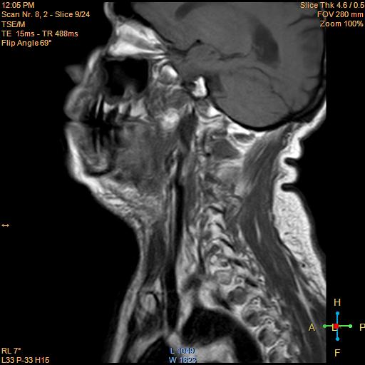 File:Nasopharyngeal carcinoma (Radiopaedia 22375-22403 Sagittal T1 4).jpg