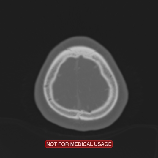 Nasopharyngeal carcinoma recurrence - skull base destruction (Radiopaedia 29107-29490 Axial bone window 12).jpg