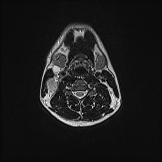 Nasopharyngeal carcinoma with perineural spread (Radiopaedia 55030-61380 Axial T2 54).jpg