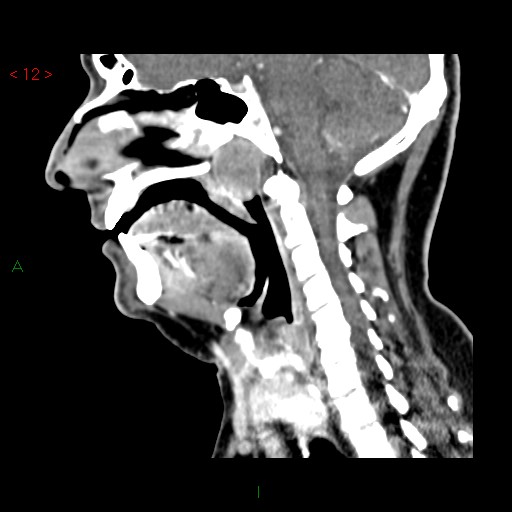 File:Nasopharyngeal lymphoma (Radiopaedia 54235-60432 B 15).jpg