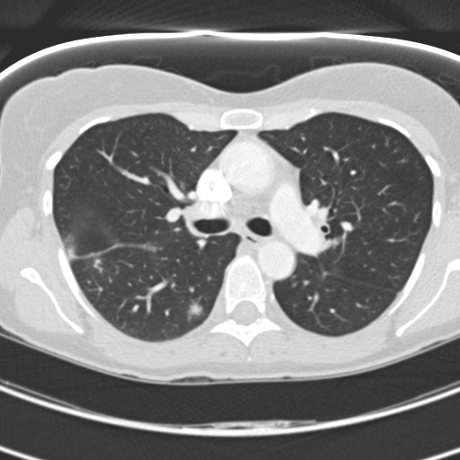 Necrobiotic pulmonary nodules - Crohn disease (Radiopaedia 20723-20631 Axial lung window 56).jpg
