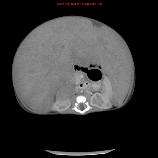 File:Neonatal neuroblastoma (Radiopaedia 9564-10223 A 28).jpg