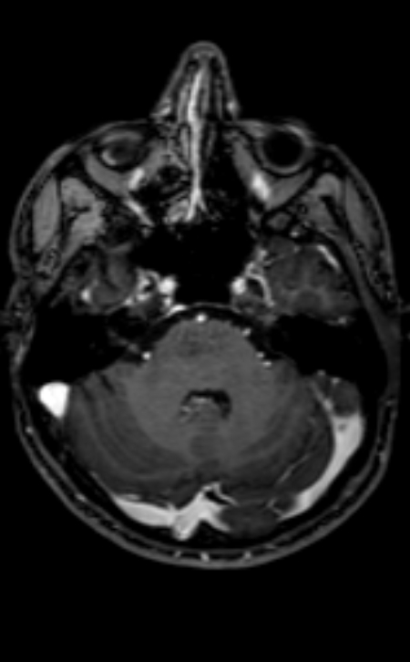 Neuro-Behçet disease (Radiopaedia 90112-107294 Axial T1 C+ 167).jpg