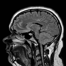 File:Neuro-Behcet's disease (Radiopaedia 21557-21506 Sagittal FLAIR 20).jpg