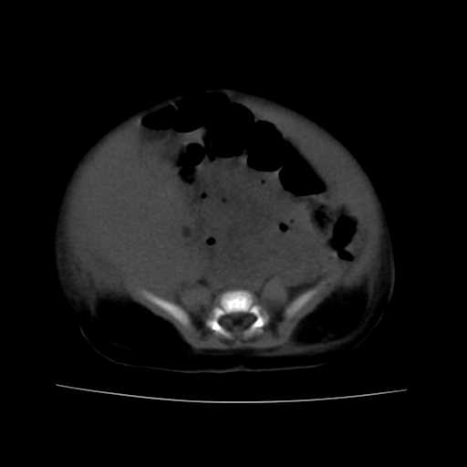 File:Neuroblastoma (Radiopaedia 20876-20799 Axial non-contrast 18).jpg