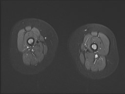 File:Neuroblastoma with bone metastases (Radiopaedia 67080-76414 Axial STIR 25).jpg