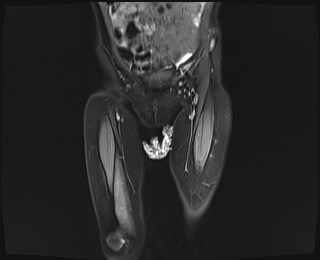 File:Neuroblastoma with bone metastases (Radiopaedia 67080-76414 Coronal STIR 4).jpg