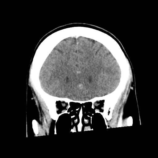 Neurocysticercosis - granular nodular (Radiopaedia 42786-45957 Coronal C+ 20).png