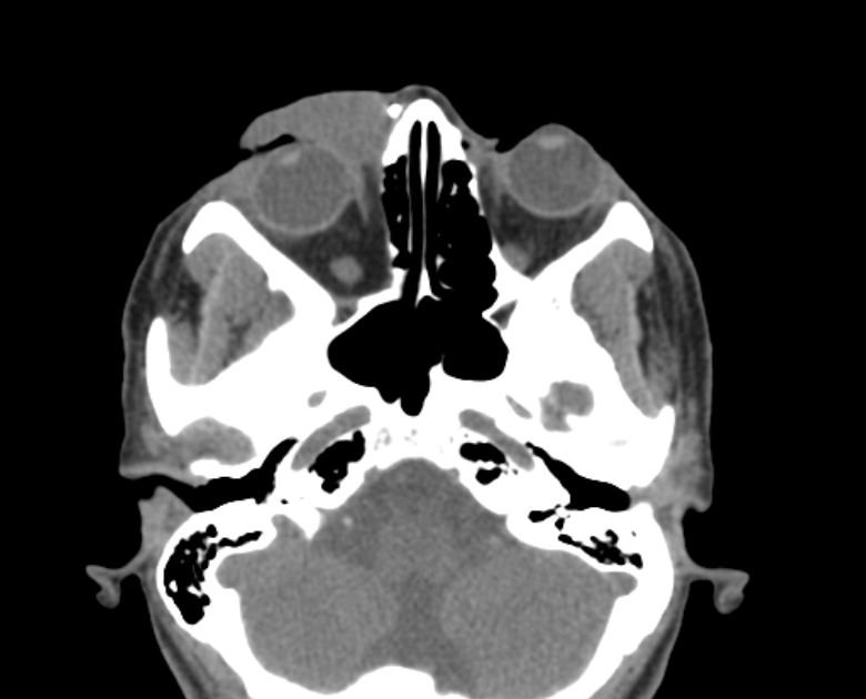 Neurofibromatosis type 1- orbital manifestations (Radiopaedia 49391-54511 Axial non-contrast 43).jpg