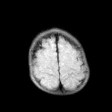 File:Neurofibromatosis type 1 (Radiopaedia 30089-30671 Axial FLAIR 20).jpg