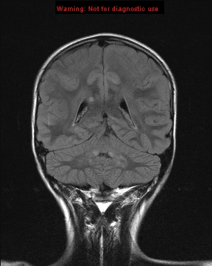 File:Neurofibromatosis type 1 with optic nerve glioma (Radiopaedia 16288-15965 Coronal FLAIR 8).jpg