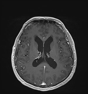 Neurofibromatosis type 2 (Radiopaedia 79097-92049 Axial T1 C+ 116).jpg