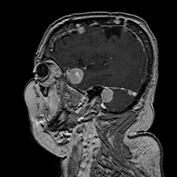 File:Neurofibromatosis type 2 (Radiopaedia 8713-9518 Sagittal T1 C+ 13).jpg