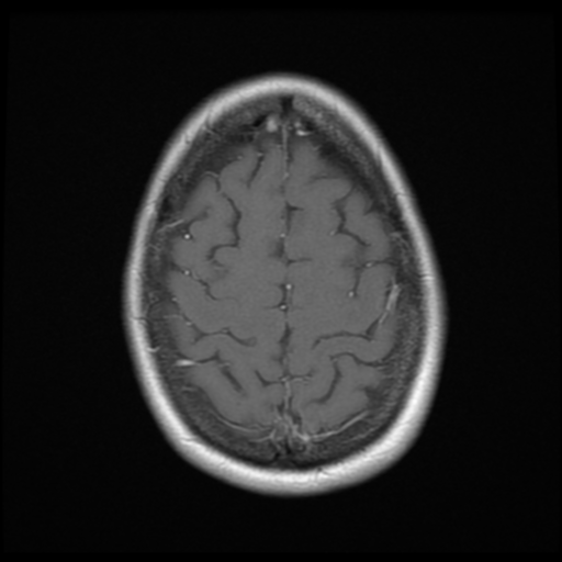 File:Neurofibromatosis type 2 - bilateral acoustic neuromata (Radiopaedia 40060-42566 Axial T1 C+ 18).png