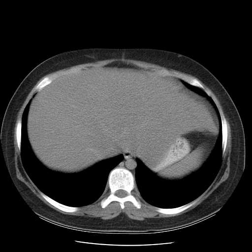 File:Non-Hodgkin lymphoma involving pelvis (Radiopaedia 21281-21197 B 11).jpg
