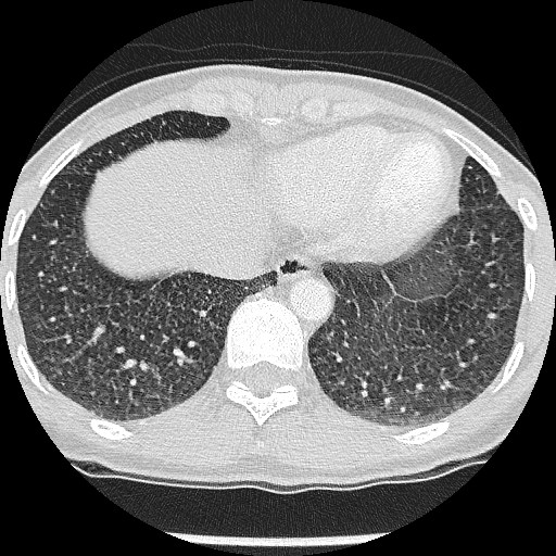 File:Non-small cell lung cancer with miliary metastases (Radiopaedia 23995-24193 Axial lung window 20).jpg