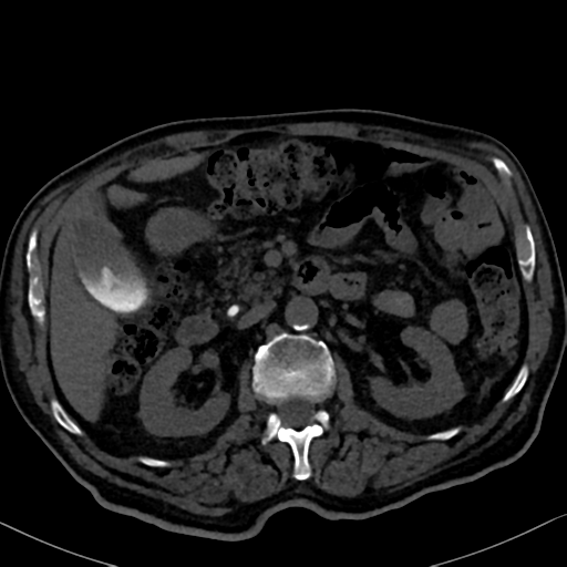 File:Normal CT intravenous cholangiogram (Radiopaedia 38199-40208 Axial IVC 45).png