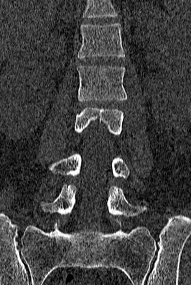 Normal CT lumbar spine (Radiopaedia 53981-60118 Coronal bone window 32).jpg