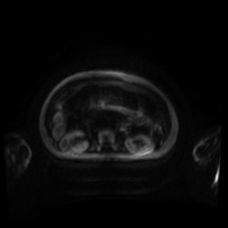 Normal MRI abdomen in pregnancy (Radiopaedia 88001-104541 Axial DWI 118).jpg