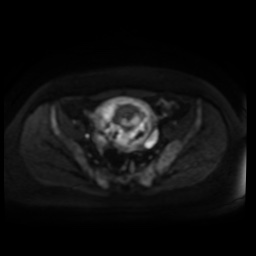 Normal MRI abdomen in pregnancy (Radiopaedia 88005-104548 Axial DWI 57).jpg