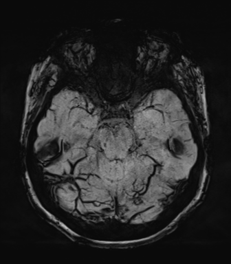 Normal MRI internal auditory canal (Radiopaedia 41613-44525 Axial SWI MIP 27).png