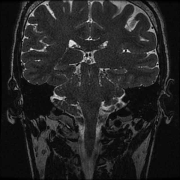 Normal MRI petrous (Radiopaedia 91317-108949 Coronal T2 71).jpg