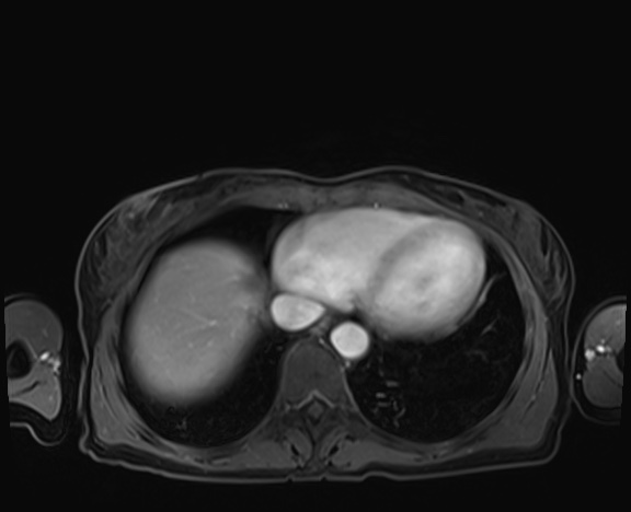 Normal adrenal glands MRI (Radiopaedia 82017-96004 K 6).jpg