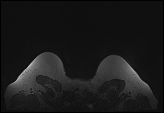 File:Normal breast MRI - dense breasts (Radiopaedia 80454-93850 Axial T1 215).jpg