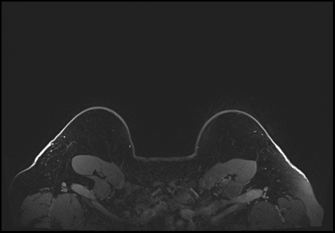 Normal breast MRI - dense breasts (Radiopaedia 80454-93850 C 218).jpg