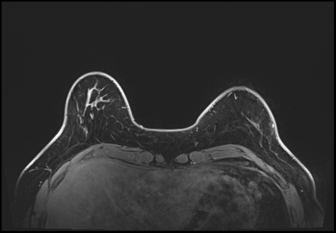 Normal breast MRI - dense breasts (Radiopaedia 80454-93850 C 44).jpg