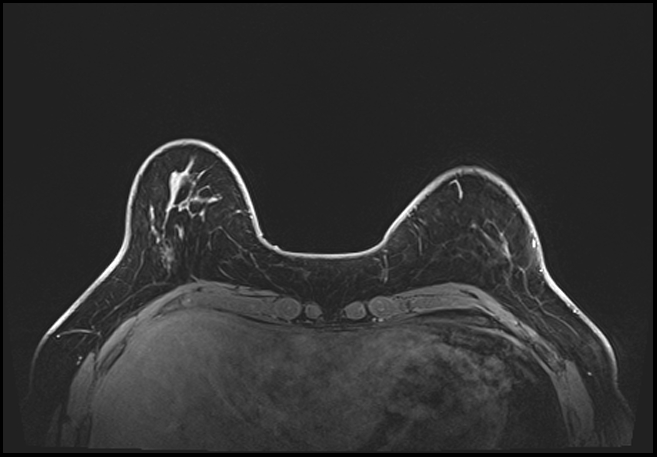 Normal breast MRI - dense breasts (Radiopaedia 80454-93850 C 45).jpg