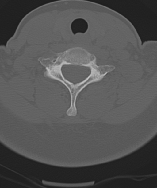 Normal cervical spine MRI (including Dixon) (Radiopaedia 42762-45926 Axial bone window 43).png
